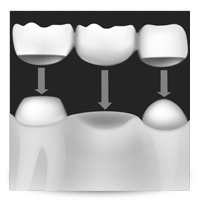 Differences between Dental Veneers and Caps